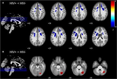 Morphological Changes of <mark class="highlighted">Frontal Areas</mark> in Male Individuals With HIV: A Deformation-Based Morphometry Analysis